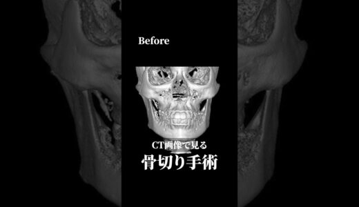 【CT公開】張り出していたエラが…#骨切り #輪郭形成 #美容整形 #shorts