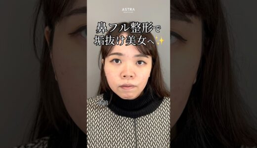 【鼻フル整形で垢抜け美女💞#忘れ鼻#鼻整形#美容整形#astrabeautyclinic#塩満恵子】