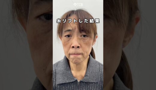 【糸リフト】衝撃の変化💥💥#shorts