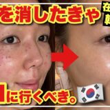 【韓国旅行シミ取り完全ガイド】チョンダムジェイクリニックでレーザー治療してみた結果がコレ【韓国美容皮膚科の無加工&リアルレポ】