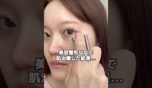 美容整形せずに肌治療してみたら…カタンニードルショットおすすめだよ🫶#美容 #スキンケア #韓国コスメ #導入美容液 #katan #毛穴 #pr