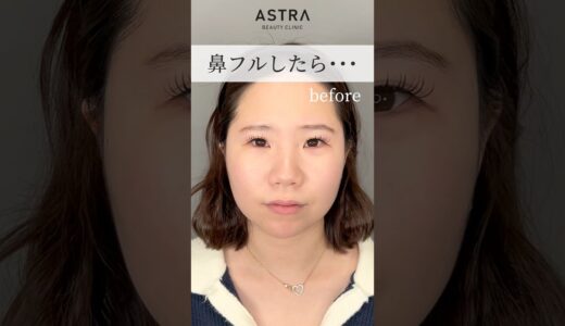 激変🙀💖#astrabeautyclinic  #アストラビューティークリニック #塩満恵子 #鼻整形 #美容整形