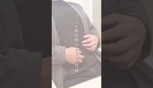 50歳からの脂肪吸引ビフォーアフターがすごい！