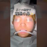 理想の鼻に😳✨#astrabeautyclinic  #アストラビューティークリニック #塩満恵子 #鼻整形 #美容整形