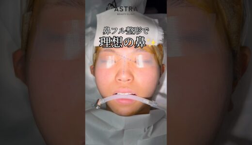 理想の鼻に😳✨#astrabeautyclinic  #アストラビューティークリニック #塩満恵子 #鼻整形 #美容整形