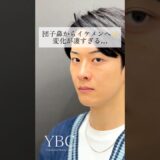 【衝撃】団子鼻からイケメンへ✨#美容 #美容整形 #鼻整形