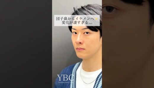 【衝撃】団子鼻からイケメンへ✨#美容 #美容整形 #鼻整形