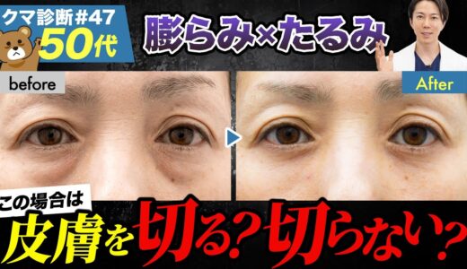 【目の下のたるみ】たるみが強いクマでも「切らない」クマ取り治療が可能か徹底解説！［クマ診断＃047］#目の下のたるみを取る方法#目の下のたるみ#クマ取り #美容整形 #湘南美容クリニック