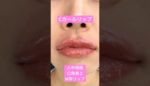 Cカールリップで垢抜け❤️ #shorts #美容 #美容整形 #ビフォアーアフター #垢抜け #整形