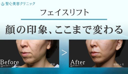 【顔のたるみを劇的改善】〜フェイスリフト手術のすべて〜【聖心美容クリニック】#フェイスリフト #たるみ改善 #若返り整形 #美容整形 #ほうれい線 #マリオネットライン #顔のたるみ #美肌再生