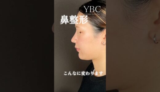 【衝撃】鼻整形こんなに変わります　#美容整形 #鼻整形 #ybc横浜美容外科