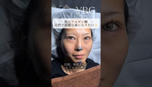 ヒアルロン酸卒業！念願の鼻整形したら　#美容整形 #鼻整形 #ybc横浜美容外科