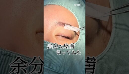 【美容整形】余分な皮膚を3cm切ってみた#shorts