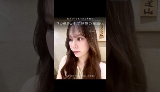 爆美女の鼻整形に密着　#鼻整形 #鼻尖形成 #美容整形 #形成外科専門医 #美容 #垢抜け