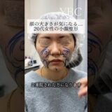 念願の小顔整形したら　#美容整形 #脂肪吸引 #ybc横浜美容外科