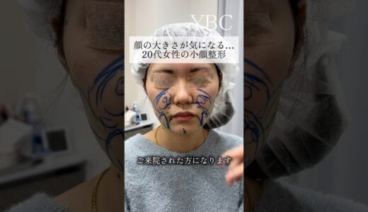 念願の小顔整形したら　#美容整形 #脂肪吸引 #ybc横浜美容外科