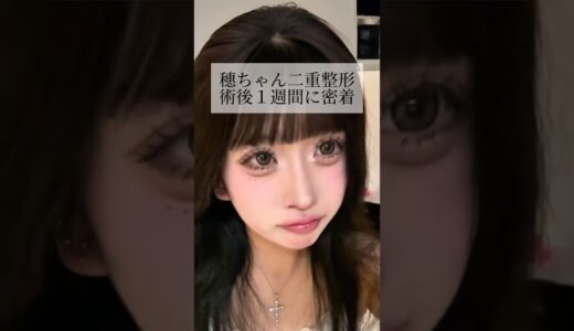 【二重整形】#shorts 術後１週間まで密着