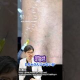 手の甲は絶対にやらないで#脂肪注入 #整形 #美容 #美容整形 #手の甲のボコボコ #額こめかみ #頬コケ #shorts