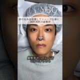 念願の鼻整形したら　#美容整形 #鼻整形 #ybc横浜美容外科