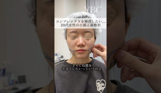 念願の鼻整形したら　#美容整形 #鼻整形 #ybc横浜美容外科