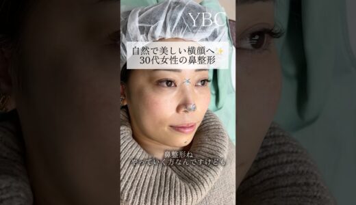 念願の鼻整形したら　#美容整形 #鼻整形 #ybc横浜美容外科