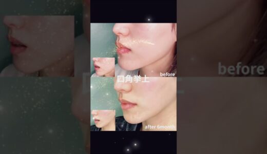 #くさのたろうクリニック #宮本大#美容整形 #口角挙上#垢抜け #美容 #口角挙上術 #m式スマイルデザイン #笑顔#印象アップ
