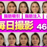 【若返り手術ダウンタイム】50代母が美容整形に初挑戦。6ヶ月間のリアルなダウンタイム経過を詳細レポート！