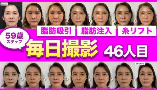 【若返り手術ダウンタイム】50代母が美容整形に初挑戦。6ヶ月間のリアルなダウンタイム経過を詳細レポート!