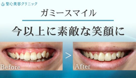 【歯茎の見えすぎを解消】〜ガミースマイル手術で笑顔に自信を〜【聖心美容クリニック】#ガミースマイル #笑顔整形 #美容外科 #口元整形 #歯茎が見える #笑うと歯茎 #コンプレックス解消