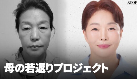 中年レジェンド整形手術レビュー│切開リフト、額挙上、顔の脂肪吸引、脂肪移植、上下眼瞼ぜんぶしました😮