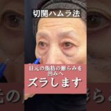 【70代のクマ取り】切開ハムラ法で膨らみ・タルミにアプローチ！【施術直後】 #shots