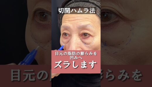 【70代のクマ取り】切開ハムラ法で膨らみ・タルミにアプローチ！【施術直後】 #shots