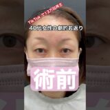 TikTok 80万再生の眉下リフトビフォーアフター！