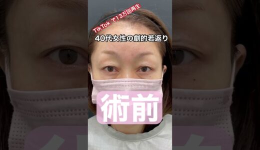 TikTok 80万再生の眉下リフトビフォーアフター！