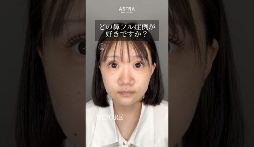 【どの鼻整形症例が好きですか？#鼻フル#鼻整形#忘れ鼻#美容整形#渋谷#塩満恵子#astrabeautyclinic 】
