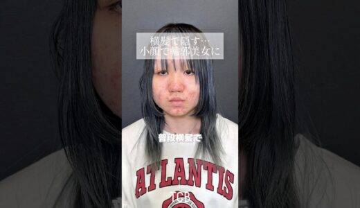 【糸リフト】横顔で隠す…小顔で輪郭美女に#shorts