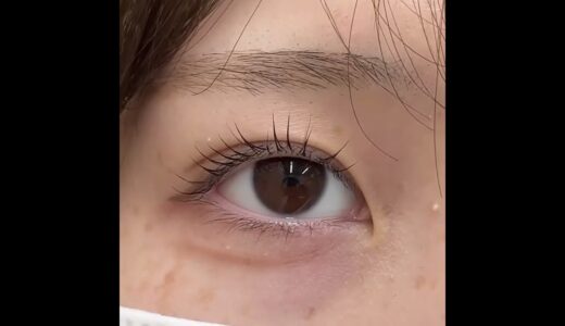 二重整形埋没法-広島美容外科メイプルクリニック-