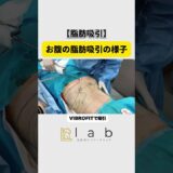 【脂肪吸引】お腹痩せ！ #脂肪吸引 #美容 #美容クリニック #美容整形