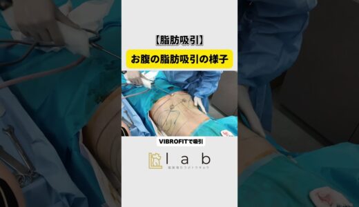 【脂肪吸引】お腹痩せ！ #脂肪吸引 #美容 #美容クリニック #美容整形