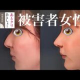 Rちゃんの鼻を魔改造した美容外科医ことアトクリが今度は鼻骨骨切り➕頬骨形成➕人中短縮で顔面機能ぶち壊して入院送りにさせたぞー！！！！