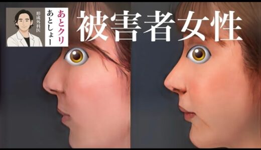 Rちゃんの鼻を魔改造した美容外科医ことアトクリが今度は鼻骨骨切り➕頬骨形成➕人中短縮で顔面機能ぶち壊して入院送りにさせたぞー！！！！