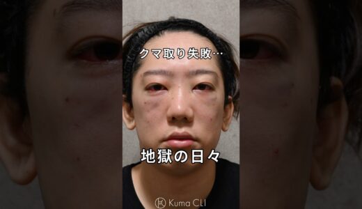 クマ取り失敗。地獄の日々…#クマ取りダウンタイム　#クマ取り #ダウンタイム