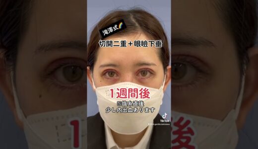 【滝澤式切開二重】眼瞼下垂☆全切開ダウンタイム