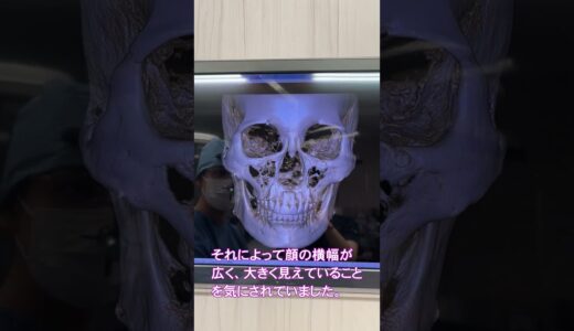 頬骨骨切りは実際どうやるの？ CTを見ながら簡単に解説（リッツ美容外科 副院長 永井 宏治）