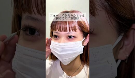 【二重整形】#shorts フォーエイトあみかちゃん
