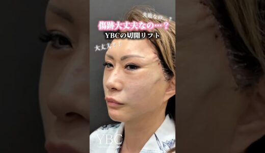 切開リフトが向いている方とは…？#美容整形 #小顔 #小顔整形