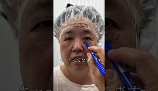 【クマ取り】60代ARASHIファン 初整形#shorts