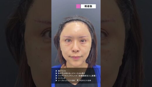 50歳女性、見た目年齢30代を目指してジェントル式若返り整形❗️