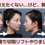 【整形密着】切開リフトしたクリニックが当たり過ぎて神💖
