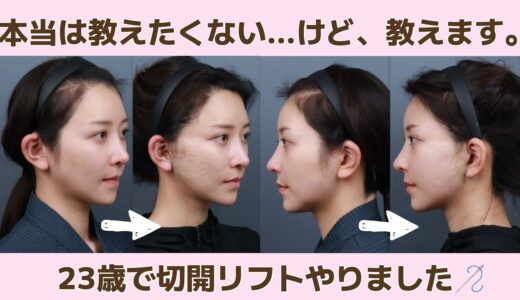 【整形密着】切開リフトしたクリニックが当たり過ぎて神💖